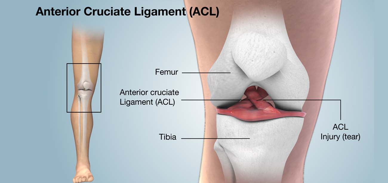 Arthroscopic ACL Reconstruction