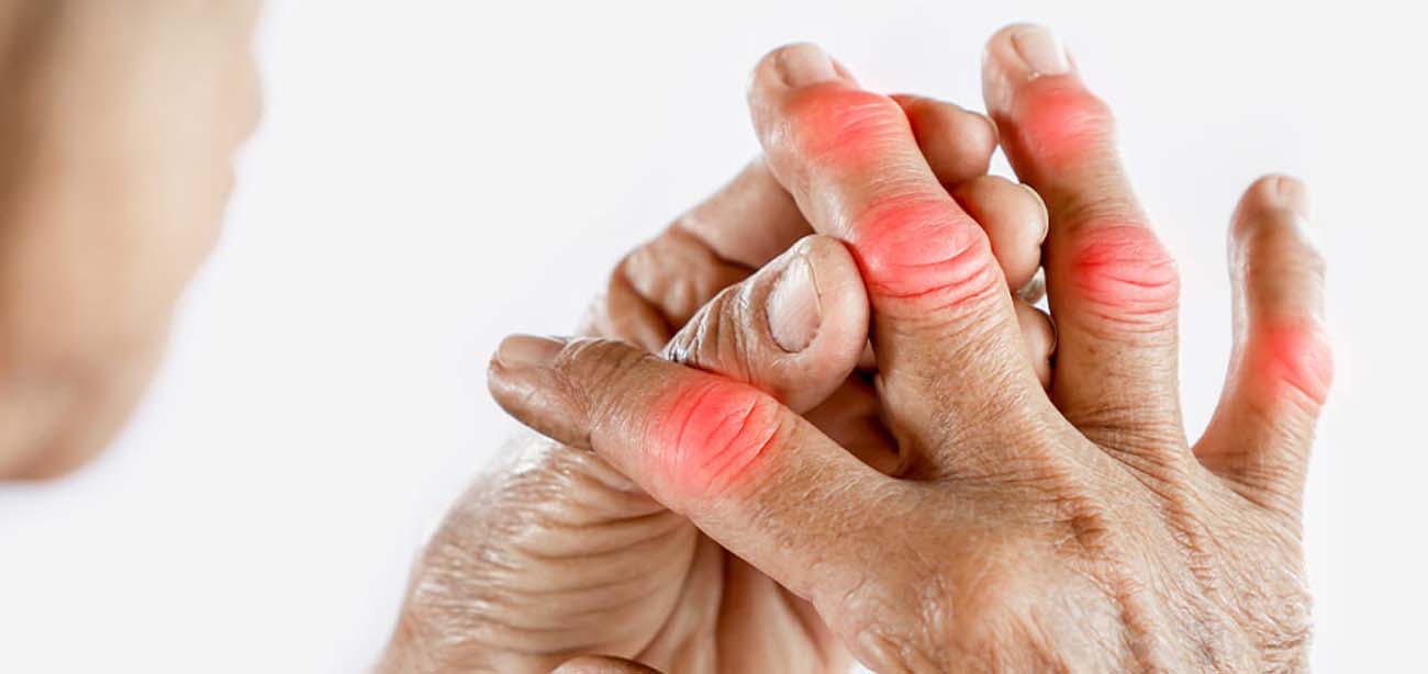 Arthritis