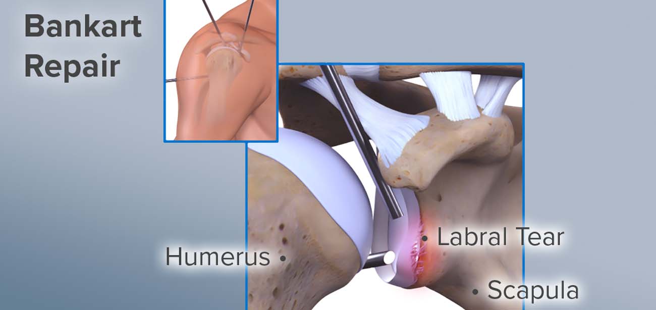 Arthroscopic Bankart Repair