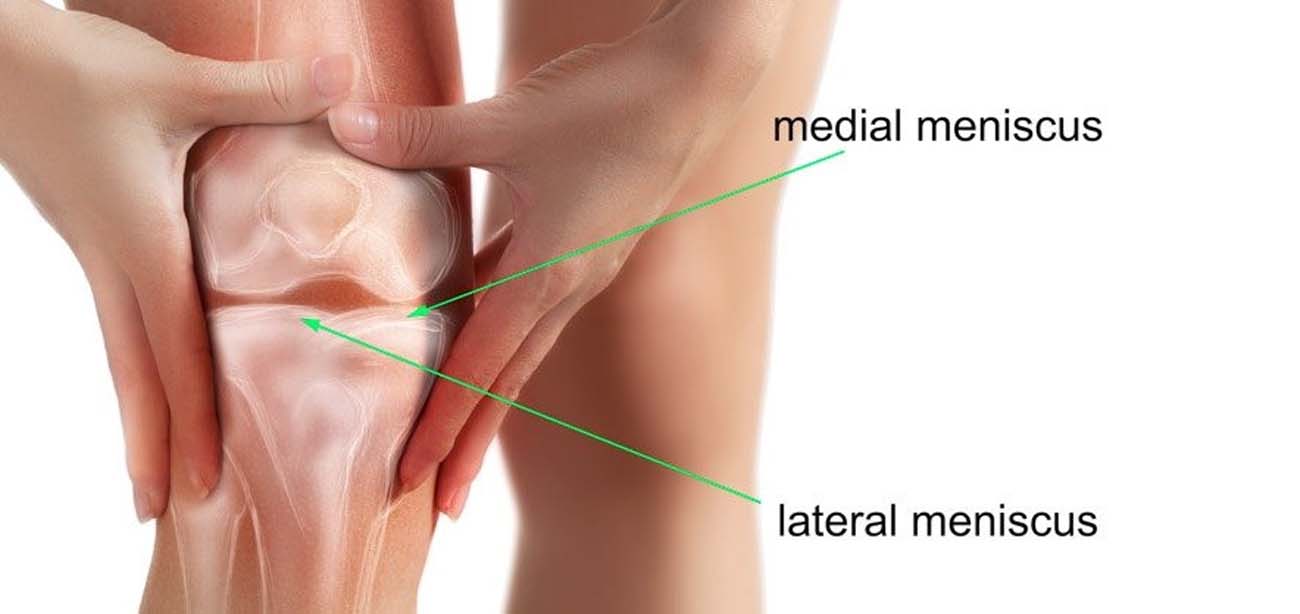 Arthroscopic Meniscectomy