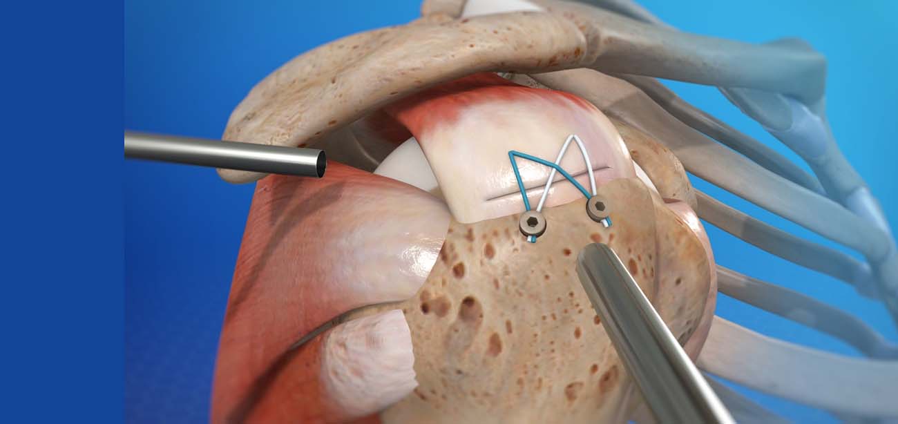 Arthroscopic Rotator Cuff Repair