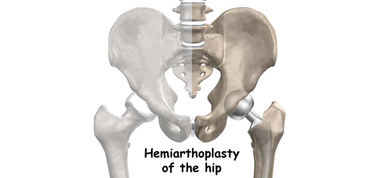 Bipolar Hemiarthroplasty