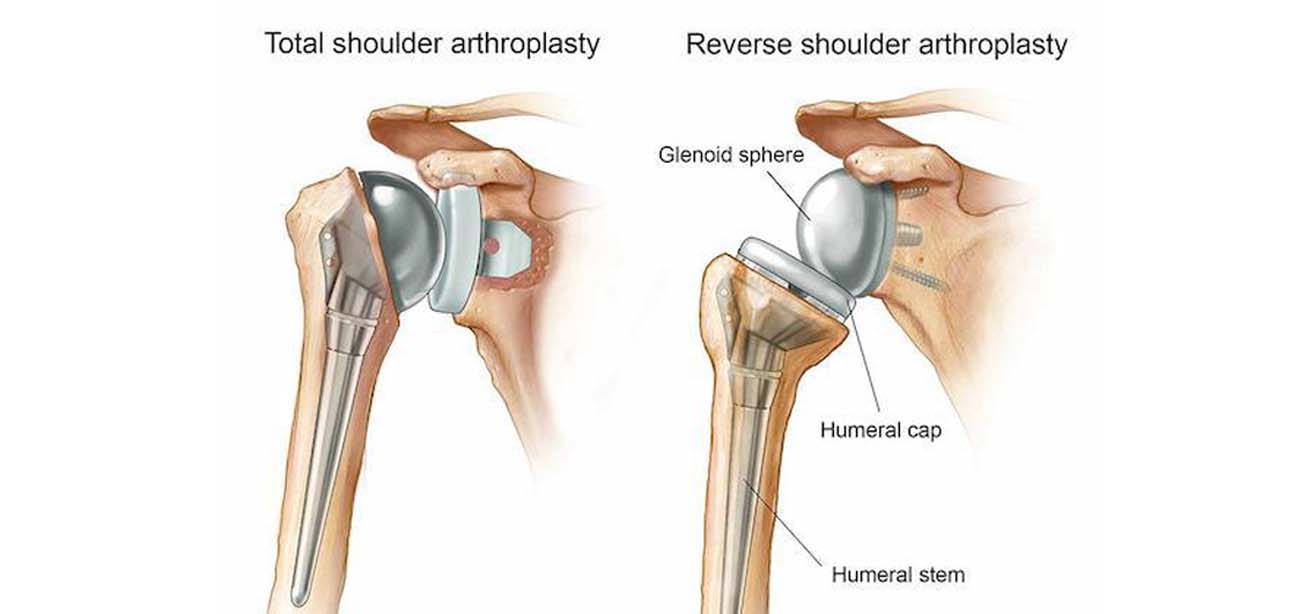 Shoulder Replacement