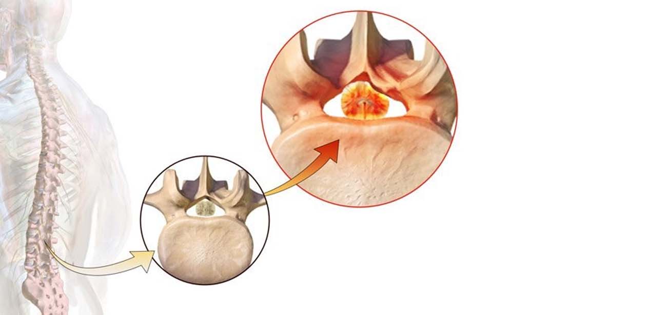 Spinal Decompression and Fixation