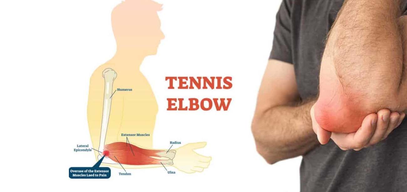 Tennis Elbow