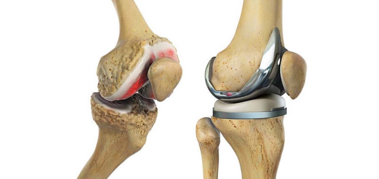 Total Knee Replacement (TKR)