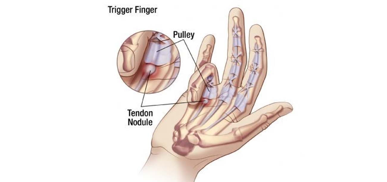 Trigger Finger